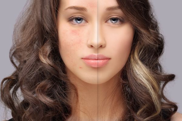efficacité des traitements contre les cicatrices : aperçu avant / après sur un le visage d'une femme