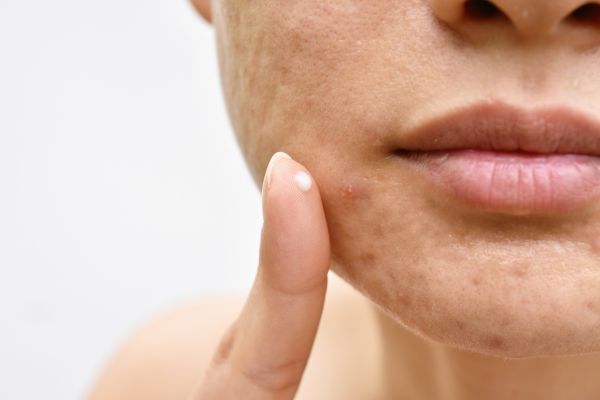 une peau avec de nombreuses cicatrices liées à l'acné